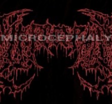 Microcephaly