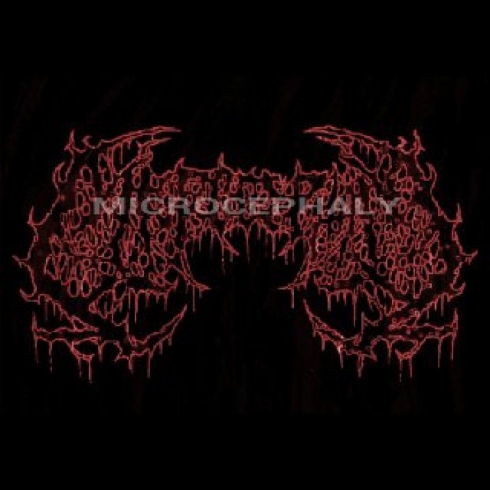 Microcephaly